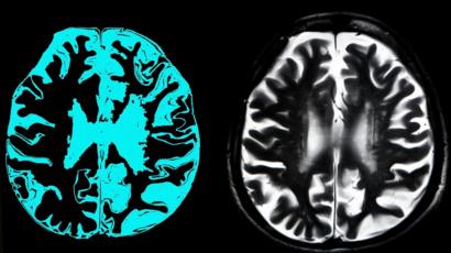 Dementia Affected Brain