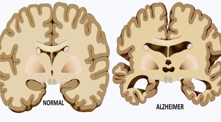 Normal Vs Alzheimer Affected Brain